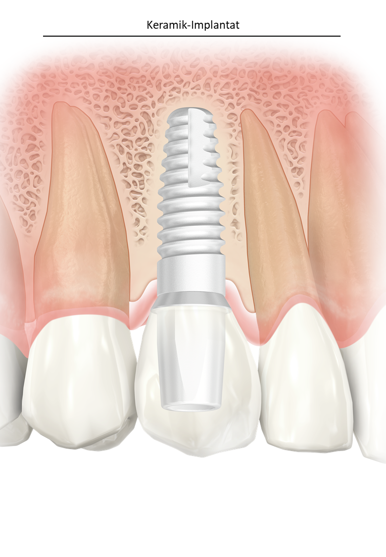 keramikimplantate-metallfreier-zahnerstaz